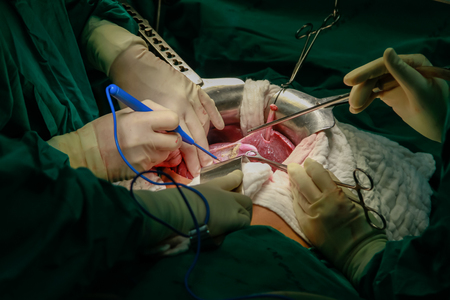 Suture with surgical forceps, needle and thread making abdomen close-upの写真素材