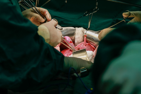 Suture with surgical forceps, needle and thread making abdomen close-upの写真素材