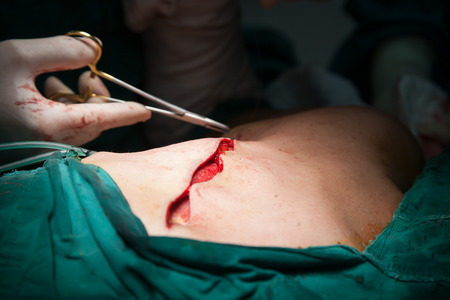 Breast cancer surgery in operating roomの写真素材