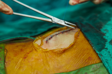 Surgeon with patient during surgery to treatment in operating room.の写真素材