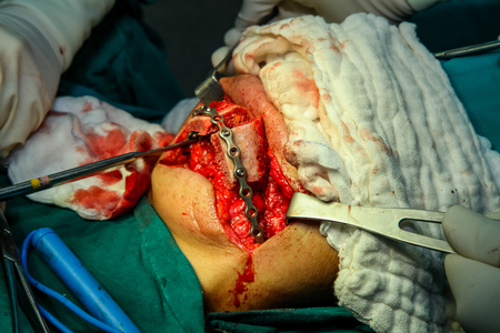 Patient during surgery to jaw bone treatment in operating room at hospital.の写真素材