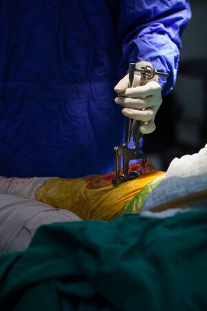 Team of doctor working at operating room in hospital. Surgeon perform total knee replacement surgery.の写真素材