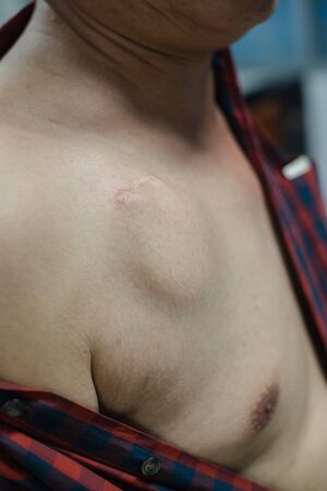 Patient with Automatic Implantable Cardioverter Defibrillator(AICD) for treatment congestive heart failure.の写真素材