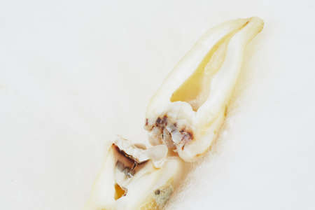 Cross section of the teeth with dental caries - selective focusの写真素材