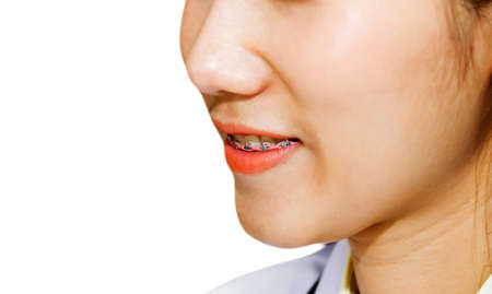 Close up the face of a beautiful Asian woman and enhance the beauty of teeth by wearing braces to enhance personality. have a beautiful smile Build confidence and chew food better : Dental treatmentの写真素材