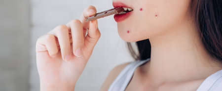 Closeup Acne Problem Face Woman Eating Chocolate bar.