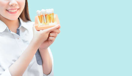 Woman holding dental example implant false tooth on pastel blue background copy space her having beautiful smileの写真素材