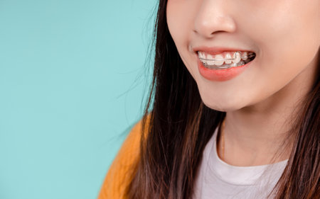 Dental Beautiful smiling of young asian woman with retainer braces glad emotion with white teeth...