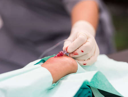 arterial line procedureの写真素材