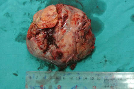 posterior mediastinal massの写真素材