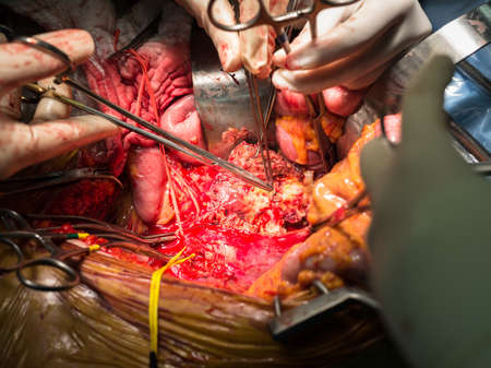 abdominal aortic aneurysm operationの写真素材