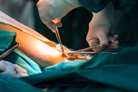 Greater saphenous vein harvest for venous conduitの写真素材