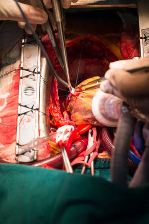 Coronary artery bypass graftingの写真素材