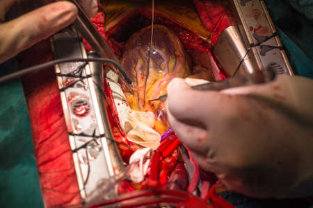Coronary artery bypass graftingの写真素材