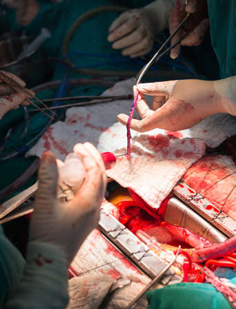 Greater saphenous vein prepaing for anastomosis in coronary arteryの写真素材