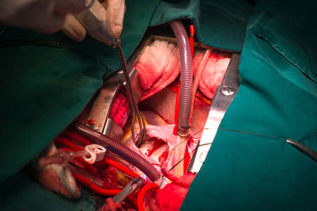 Close ventricular septal defect via tricuspid valveの写真素材