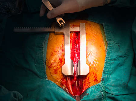 Open sternumの写真素材