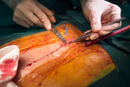 Suture close sternotomy incisionの写真素材