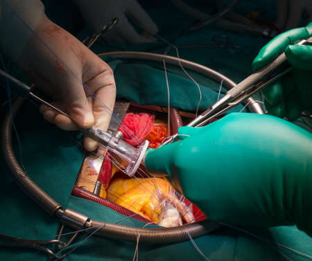 mitral valve repairの写真素材