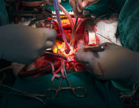 open right atriumの写真素材