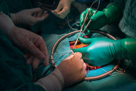 mitral valve repair