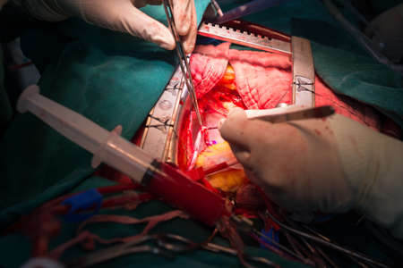 coronary artery bypass graftingの写真素材
