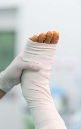 After harvest greater saphenous veinの写真素材