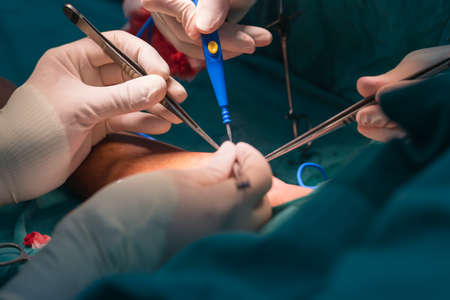 arteriovenous fistula operation for dialysis