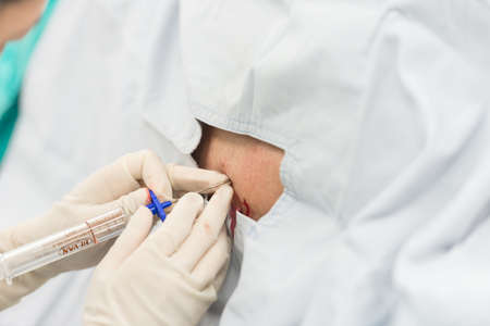 epidural block