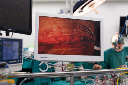behind monitor in open heart surgery