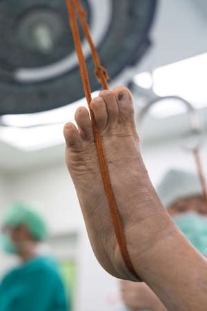 prepare foot for surgeryの写真素材