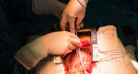 open heart surgery