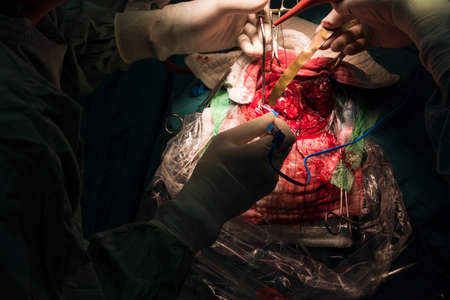 neurosurgeon remove brain tumorの写真素材