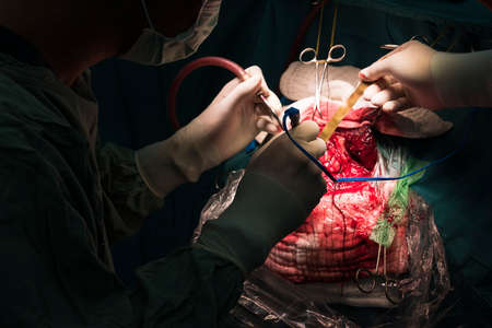 neurosurgeon remove brain tumorの写真素材