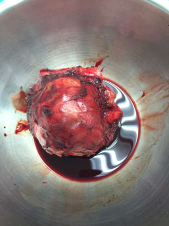 Anterior chest wall massの素材