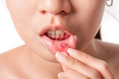 Asian women have aphthous ulcers on mouth on white background, selective focus.の写真素材
