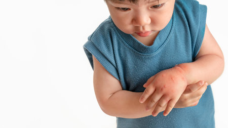 Asian baby have red swollen and blister on hand caused by insect bite, on white background.
