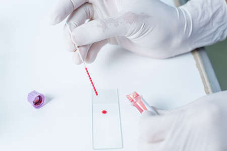 Blood sampling with needle for analysis in laboratory