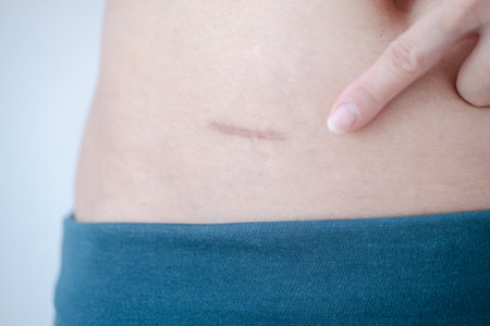 Close-up of scars after appendix surgery.の写真素材