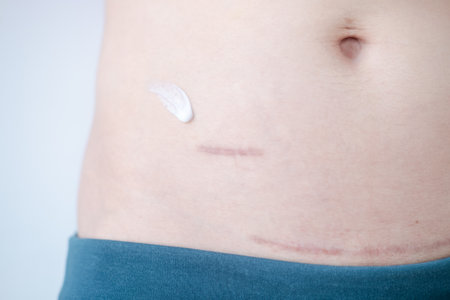 Using cream to care for scars after appendix surgery and postpartum surgical woundsの写真素材