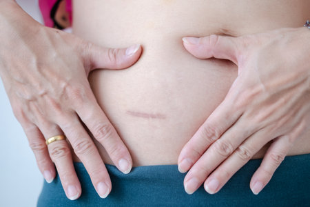 Close-up of scars after appendix surgery.の写真素材