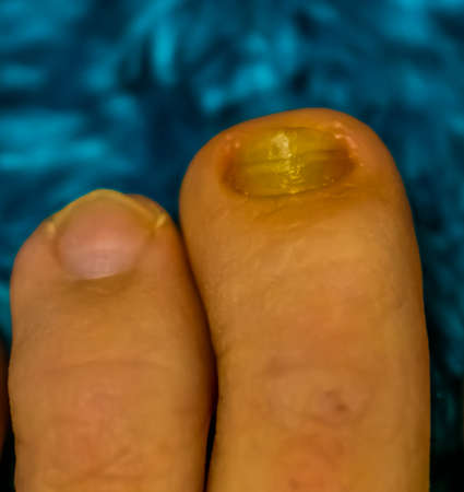 close up of healthy and a fungus infected toe nail, Common nail infection and diseaseの写真素材