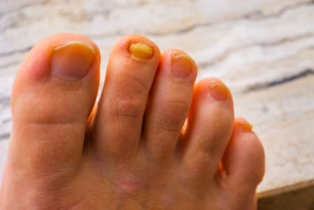 closeup of the feet with one fungus infected toe nailの写真素材