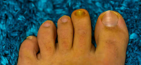 toes of the feet in close up with a fungus infected nail, common infections and diseases