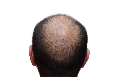 isolated male with hair loss symptoms on white backgroundの写真素材