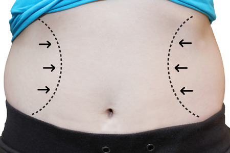 isolated female waistline about to perform liposuctionの写真素材