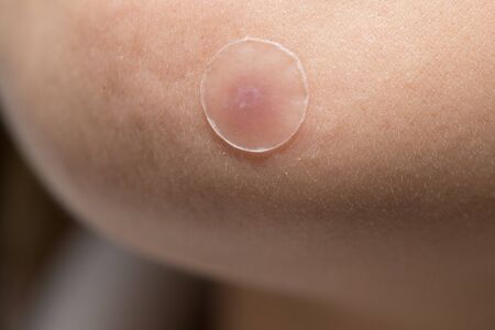 close-up on acne or pimple patch on woman skin