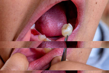Teen boy , fallen tooth. Broken, closeupの写真素材