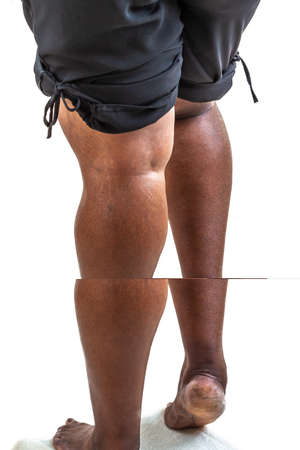 phlebologists examination -Varicose veins on the womans legs close up