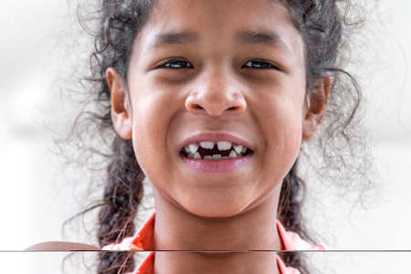 close up girl mouth with crooked broken teeth and odontolith, will need a dental applianceの写真素材